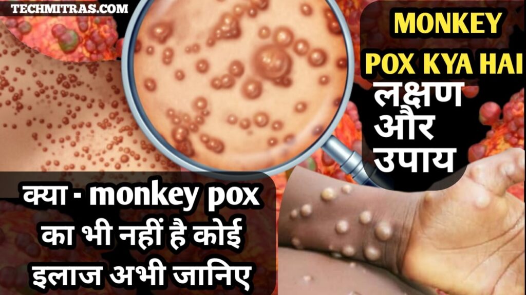 Monkeypox